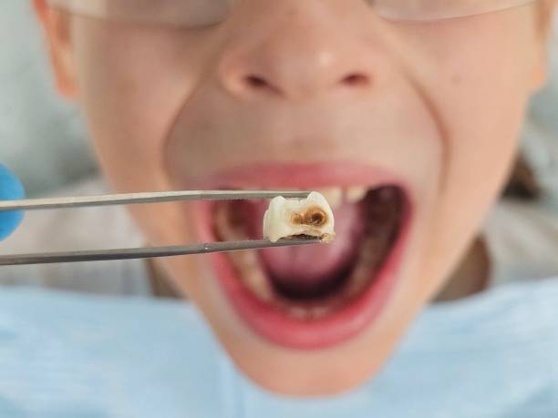 Best Emergency Dental Care for Broken or Chipped Teeth in Oconomowoc, WI